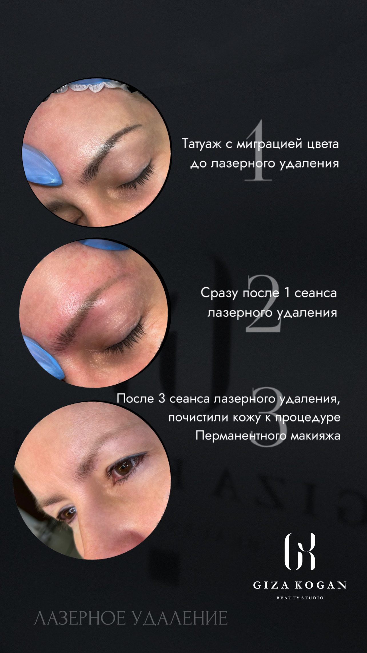 Лазерное удаление татуажа: до процедуры, после первого и после третьего сеанса